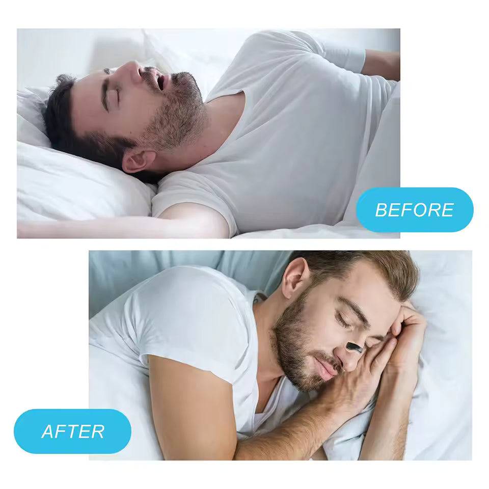 Advanced Anti-Snore Nasal Dilator Kit for Enhanced Sleep & Clear Breathing - Family Nest